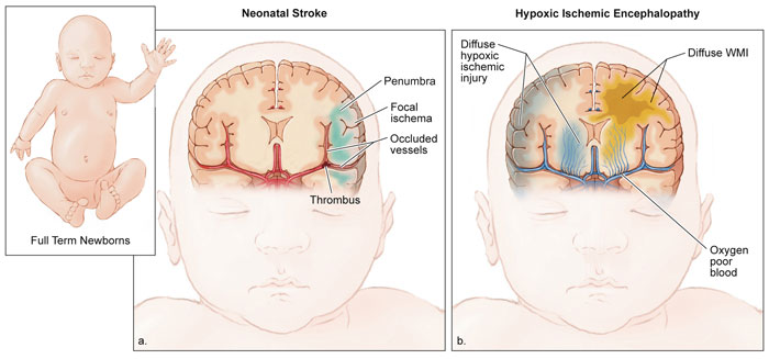 types of cerebral palsy brain