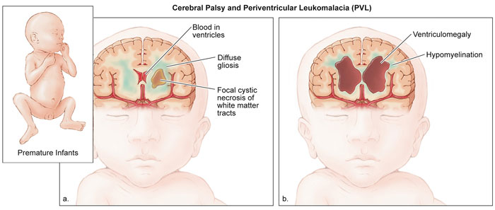 cerebral palsy children brain